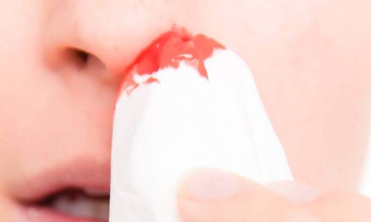  What Causes Nosebleeds? And How Can You Prevent Them?