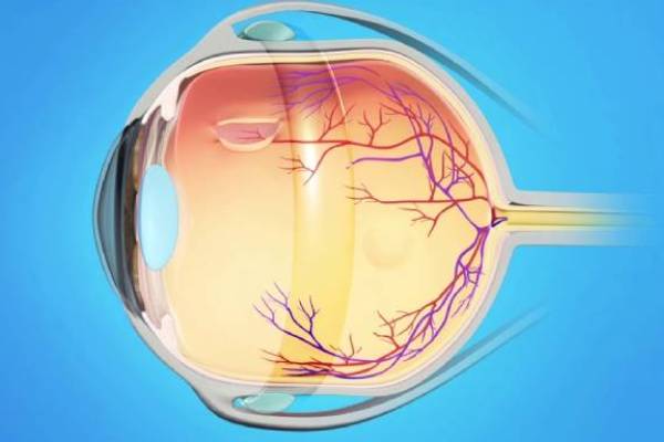 eye retina detachment operation